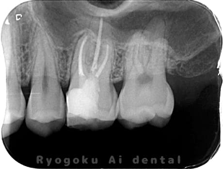 マイクロエンド術後