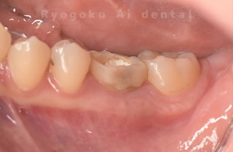 慢性根尖性歯周炎術後