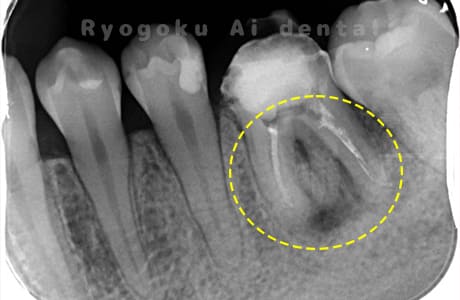 慢性根尖性歯周炎レントゲン写真術前