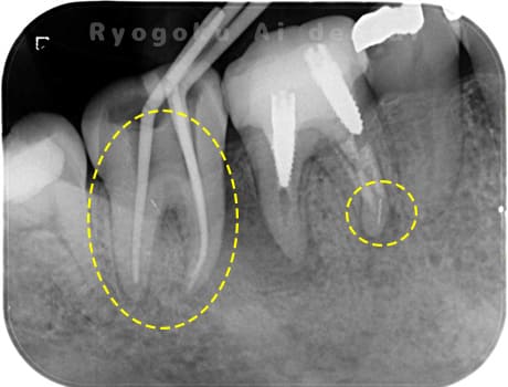 マイクロエンド術中