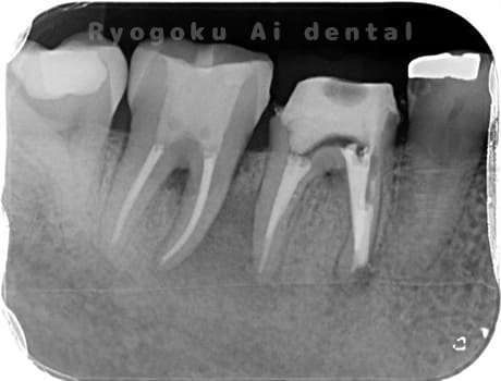 マイクロエンド術後