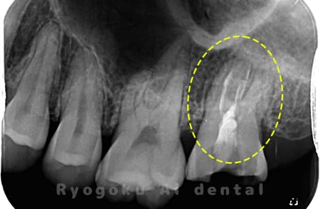 左上７番重度カリエス、慢性根尖性歯周炎レントゲン