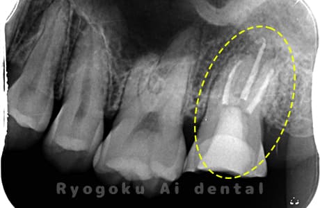 クラウンレングスニング、マイクロエンド術後レントゲン