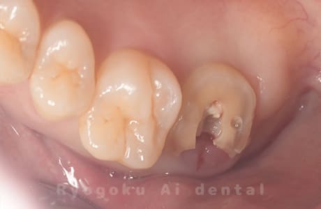 左上７番重度カリエス、慢性根尖性歯周炎