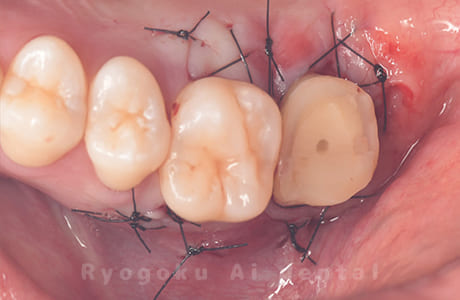 クラウンレングスニング、マイクロエンド、ジルコニアクラウン術中