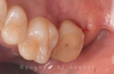 クラウンレングスニング、マイクロエンド、ジルコニアクラウン術中