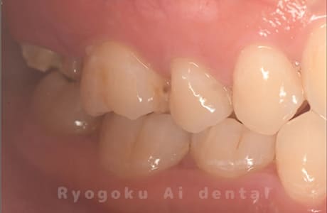 クラウンレングスニング、マイクロエンド、ジルコニアクラウン術前