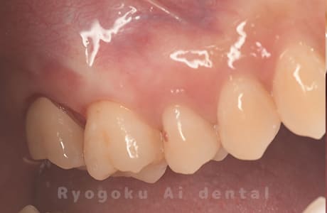 クラウンレングスニング、マイクロエンド、ジルコニアクラウン術後