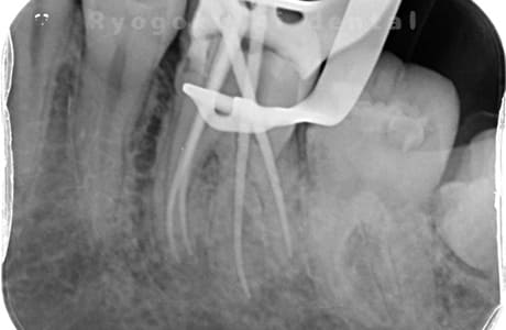 マイクロエンド術中レントゲン