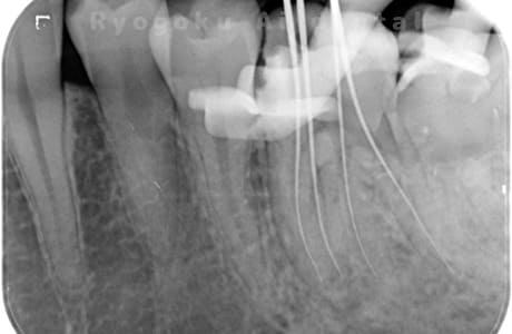 マイクロエンド術中レントゲン