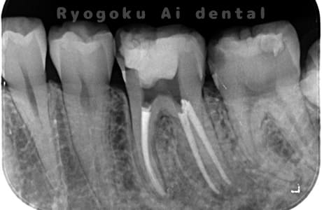 マイクロエンド術後レントゲン