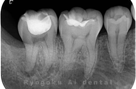慢性根尖性歯周炎レントゲン