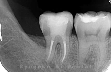 マイクロエンドレントゲン術後