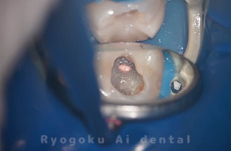 慢性根尖性歯周炎