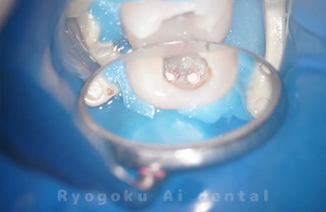 マイクロエンド術中