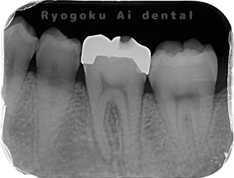 左下6番c3急化pul