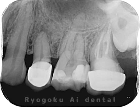 左上5番慢性根尖性歯周炎、左上6番急性化膿性根尖性歯周炎