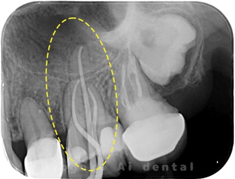 左上6番急性化膿性根尖性歯周炎術中レントゲン