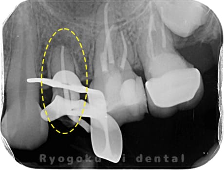 左上5番慢性根尖性歯周炎術中レントゲン