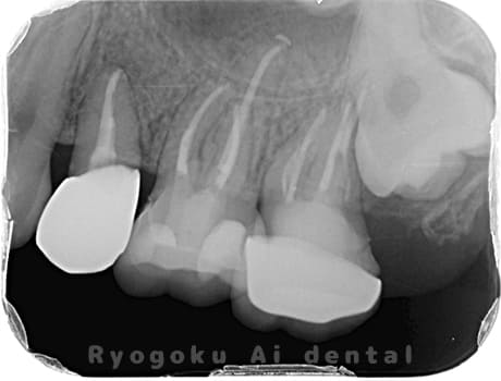 マイクロエンド治療、ジルコニアクラウン治療術後レントゲン