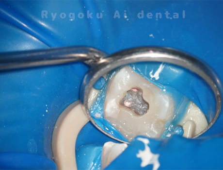 左上5番慢性根尖性歯周炎術中