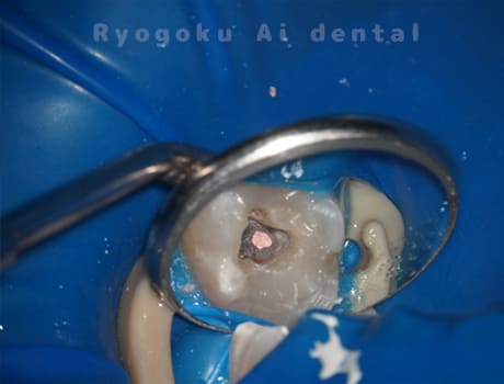 左上6番急性化膿性根尖性歯周炎術中レントゲン術中