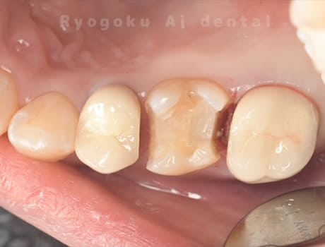 マイクロエンド治療、ジルコニアクラウン治療術中
