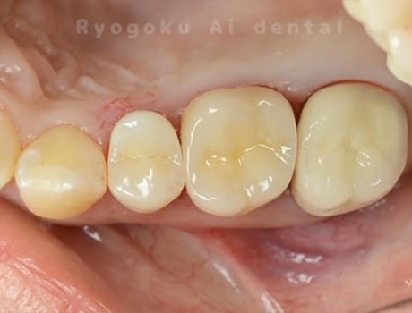 マイクロエンド治療、ジルコニアクラウン治療術後