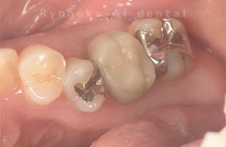 右上６番慢性根尖性歯周炎、右上５番重度カリエス