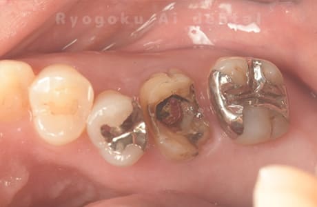 右上６番パーフォレーション