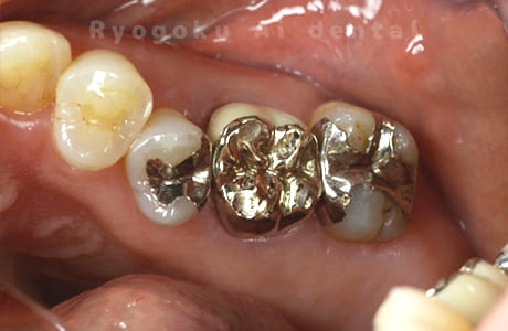 マイクロエンド治療（パーフォレーションリペア）、ゴールドクラウン修復