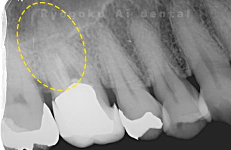 右上６番パーフォレーションレントゲン