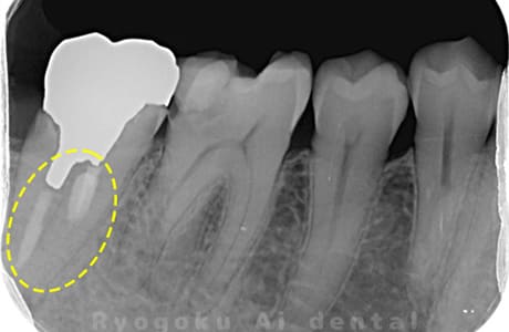 重度カリエス、不良補綴物、慢性根尖性歯周炎レントゲン写真