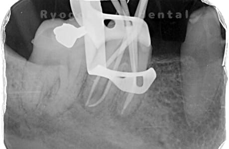 マイクロエンド術中