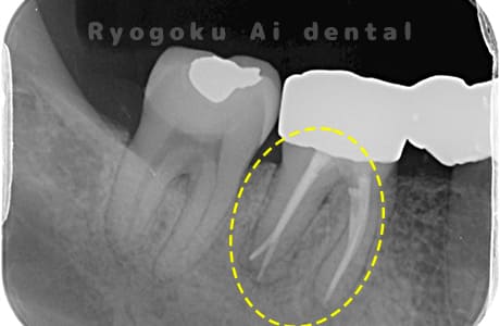 マイクロエンド術後