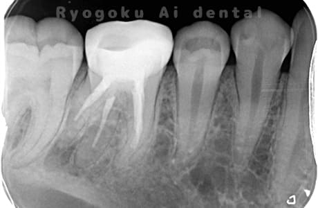 慢性根尖性歯周炎