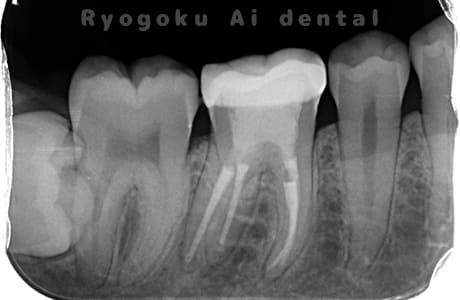マイクロエンド術後
