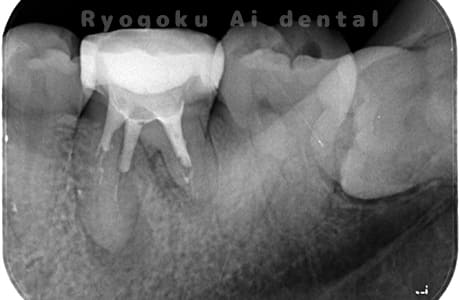 慢性根尖性歯周炎