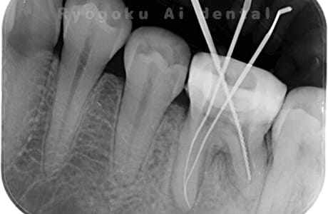 マイクロエンド治療術中レントゲン