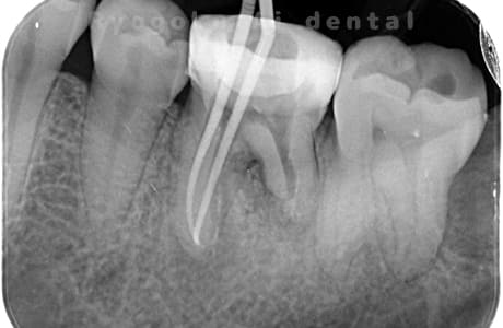 マイクロエンド治療術中レントゲン