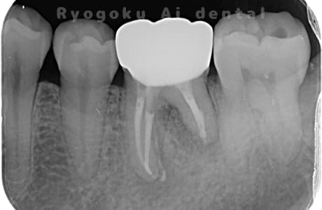 マイクロエンド治療術後レントゲン