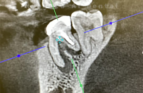 慢性根尖性歯周炎CT画像