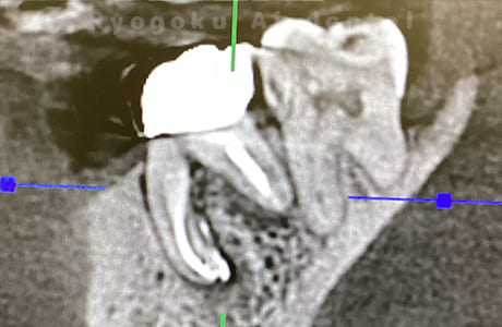 マイクロエンド治療CT画像