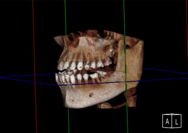 CTスキャンによる診断