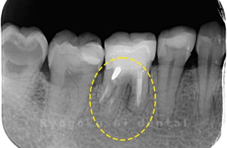右下６番パーフォレーション術前レントゲン
