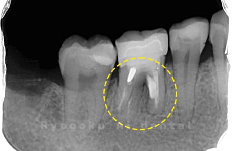 パーフォレーションリペア術後レントゲン