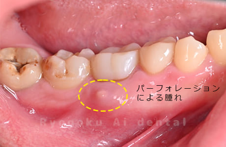 右下６番パーフォレーション術前