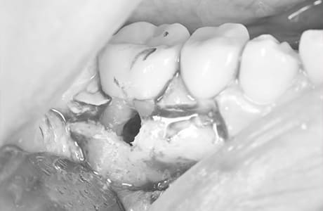 パーフォレーションリペア術中