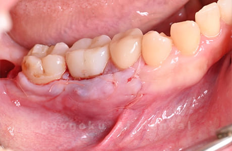 パーフォレーションリペア術中