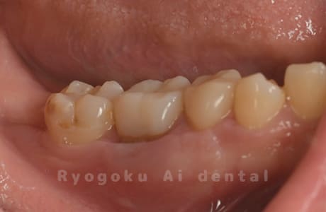 パーフォレーションリペア術後